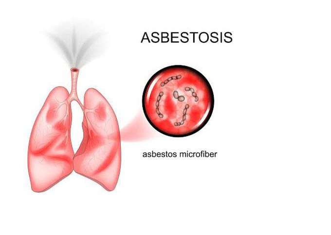 Causes of asbestosis