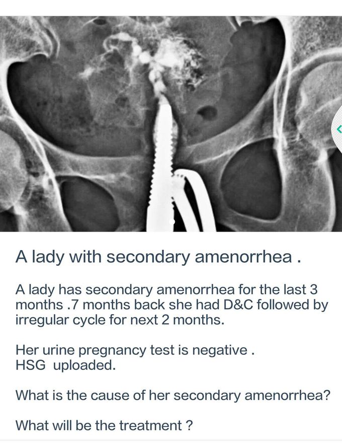 amenorrhea