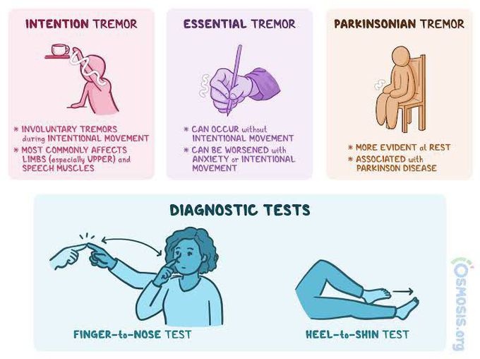 Types of Tremors