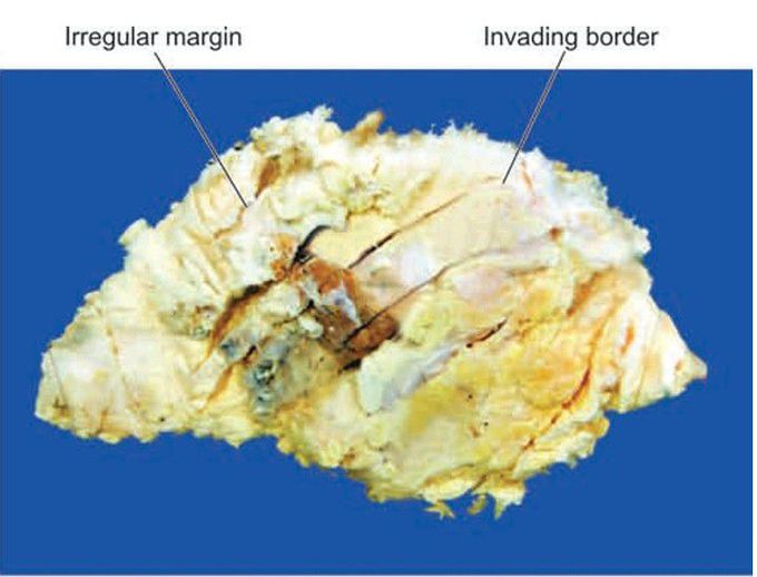 Malignant breast tumor