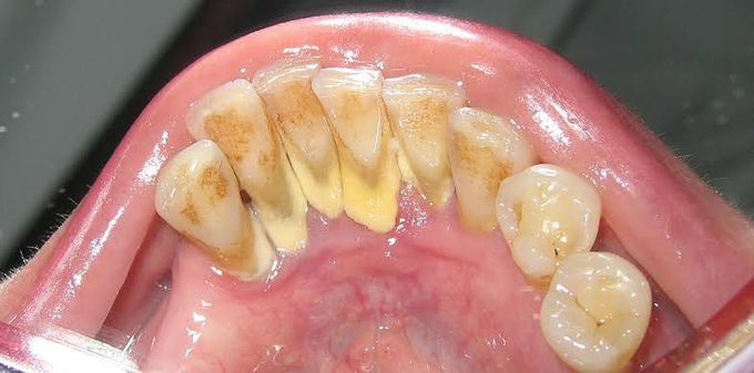 Dental calculus