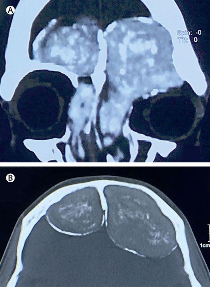 What is the probable diagnosis?