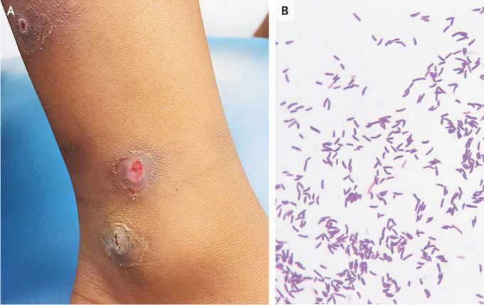 Cutaneous Diphtheria