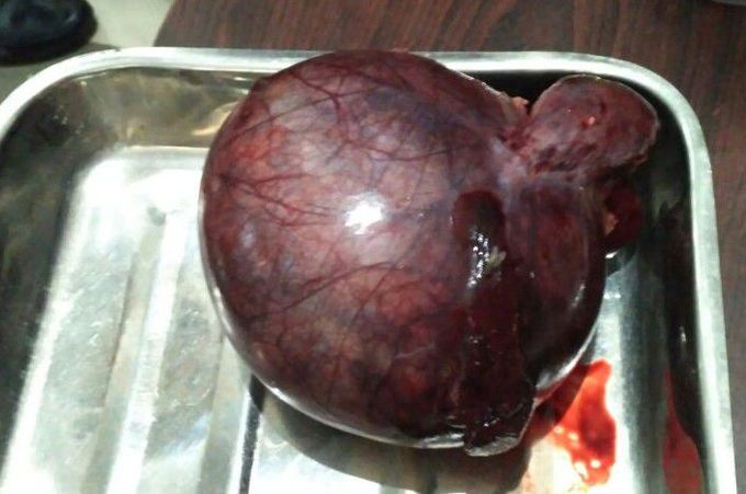 Uterine tumor of wiegh 1.5kg