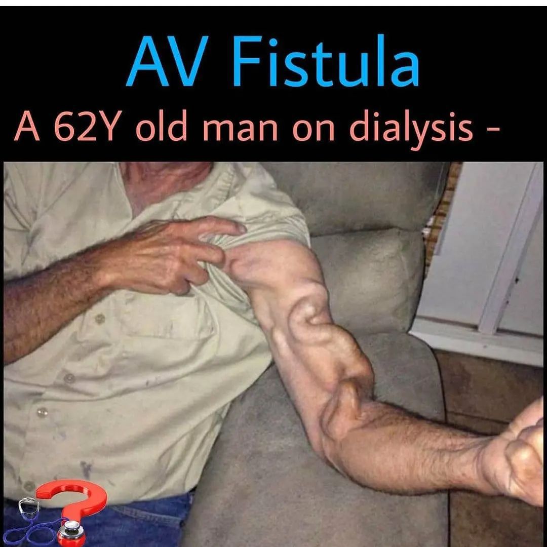 AV fistula In A 62 year old man on dialysis