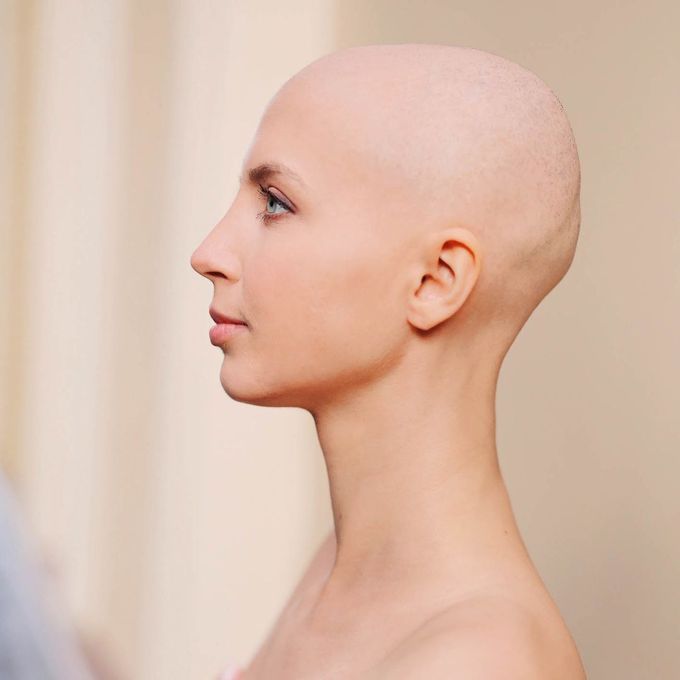 FDA OKs First Systemic Treatment for Alopecia⁠