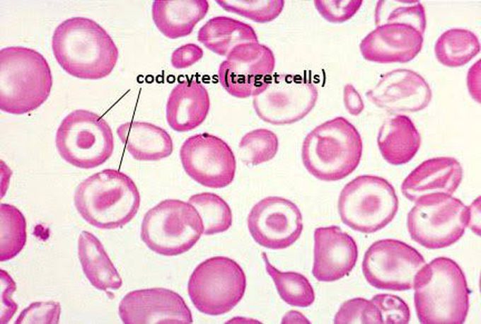 Thalassemia