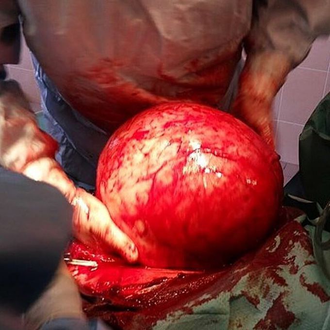 Huge cyst