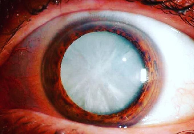 Dense white mature cataract