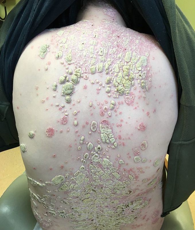 Psoriasis