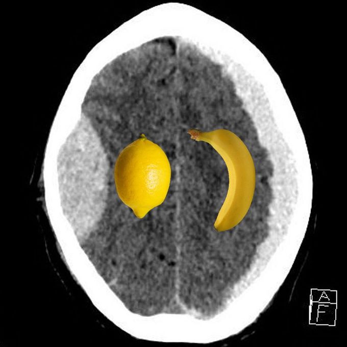 Extradural vs Subdural Hematoma