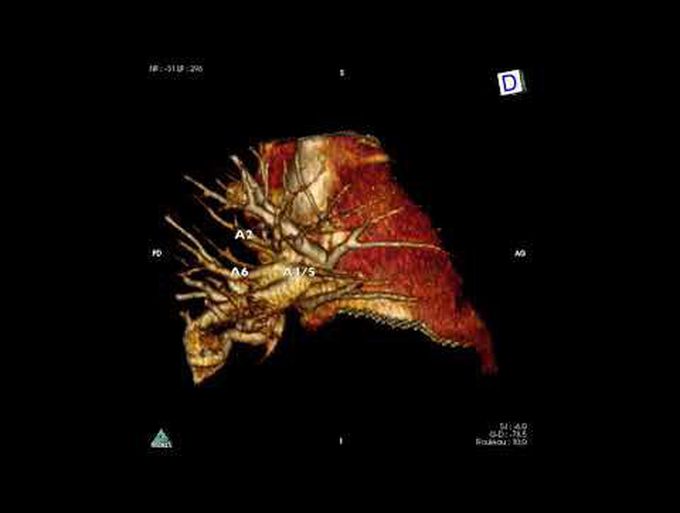 Subcostal Biportal Right Lower Lobectomy Day Surgery