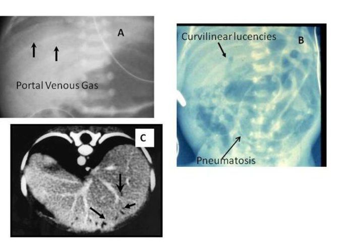 Radiolucencies indicating portal venous gas