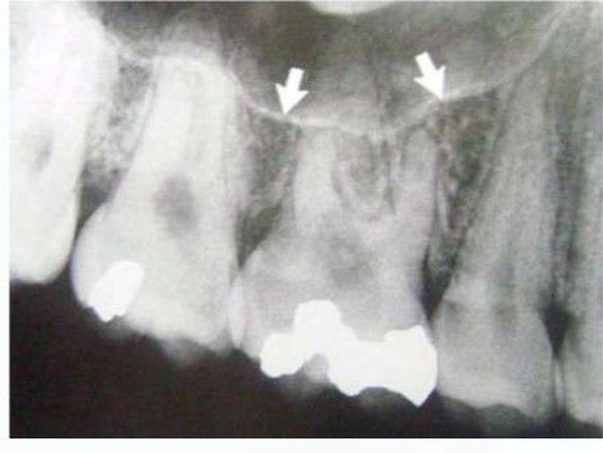 Maxillary Sinus- Inferior Border