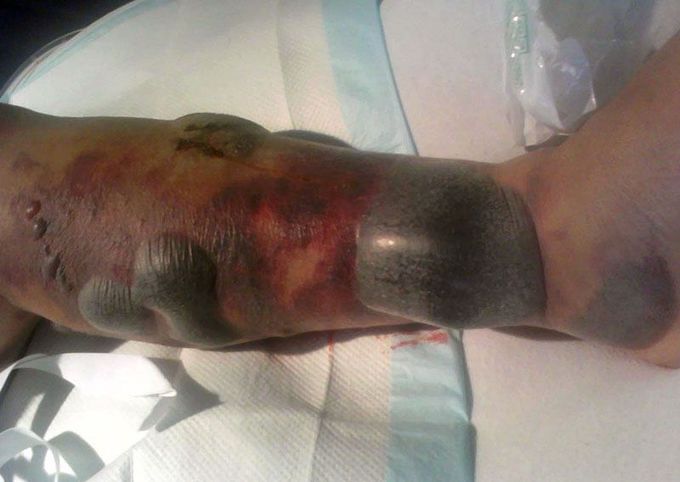 A Flesh-eating Disease: Necrotizing Fasciitis