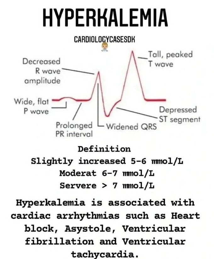 Hyperkalemia Medizzy