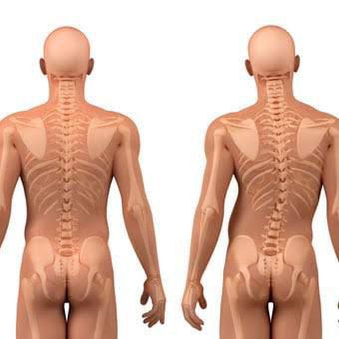 Symptoms of scoliosis in adults