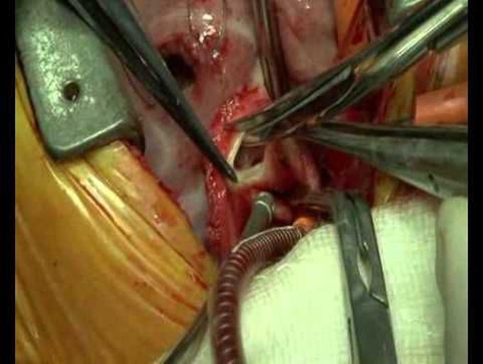 Newborn Heart Surgery