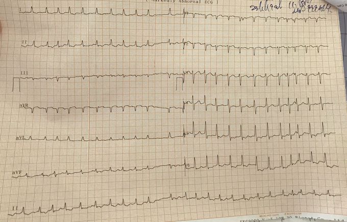 Atrial fibrillation - MEDizzy