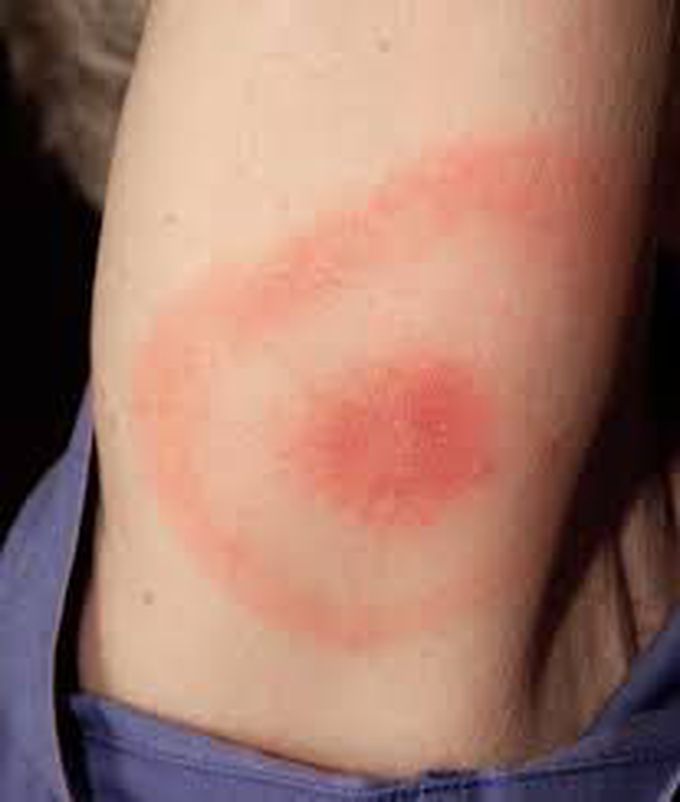 Erythema