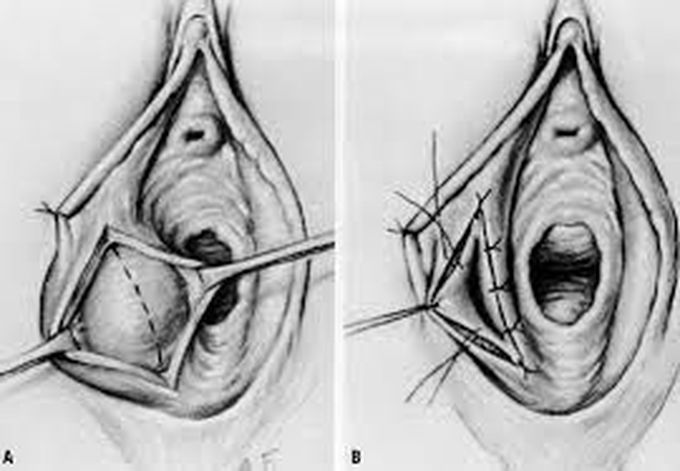 Treatment of bartholin cyst