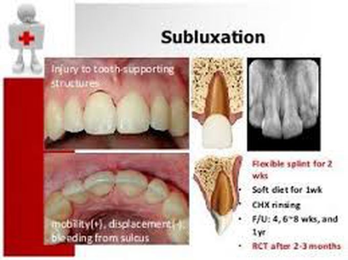 Tooth subluxation