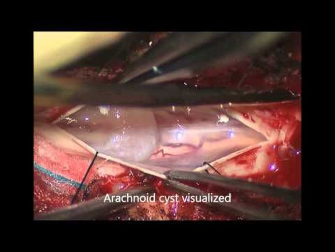Thoracic arachnoid cyst resection
