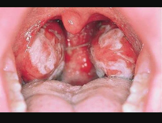 Infections mononucleosis