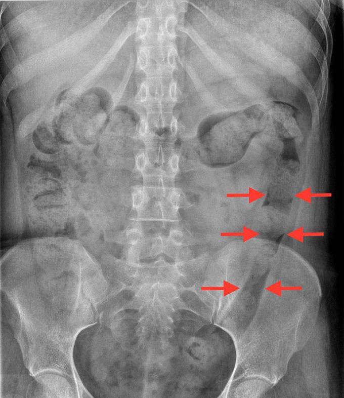 Lead pipe appearance on X-ray from loss of haustration in a patient with Ulcerative Colitis