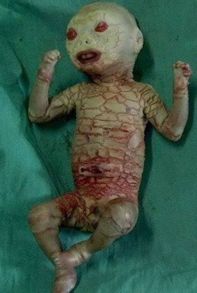 Harlequin ichthyosis