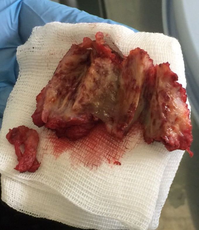 Endometriosis of postoperative scar