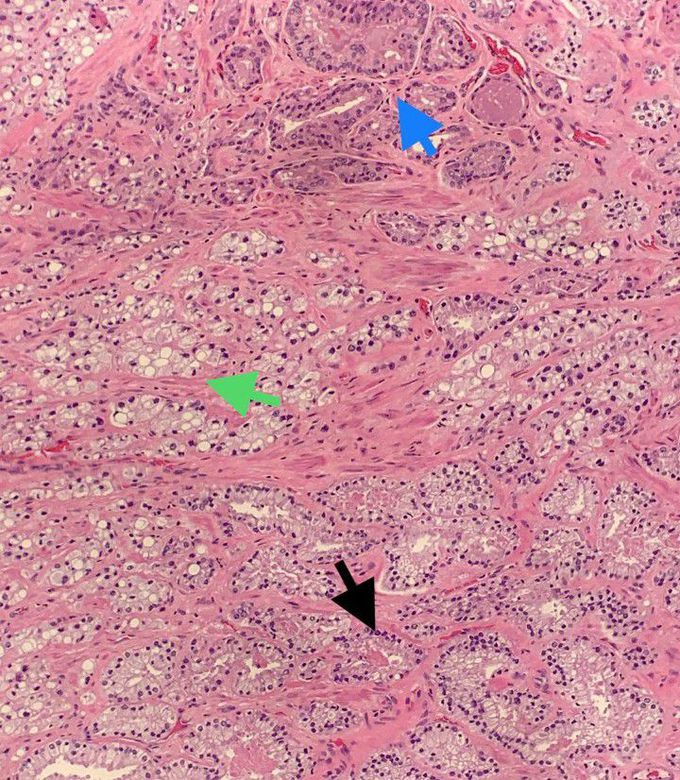 Prostatic Adenocarcinoma