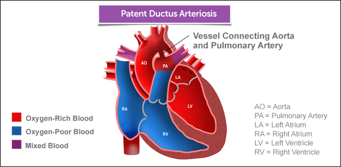 Patent ductus arteriosis