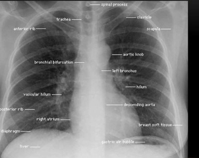 Chest x ray.