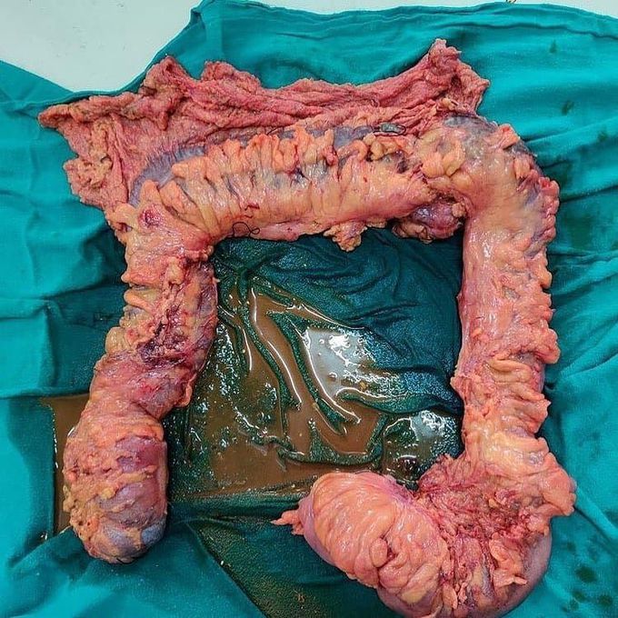 Total colectomy performed due to large bowel gangrene, from caecum to sigmoid colon.