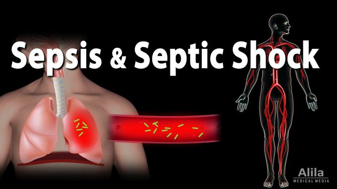 Sepsis and Septic Shock