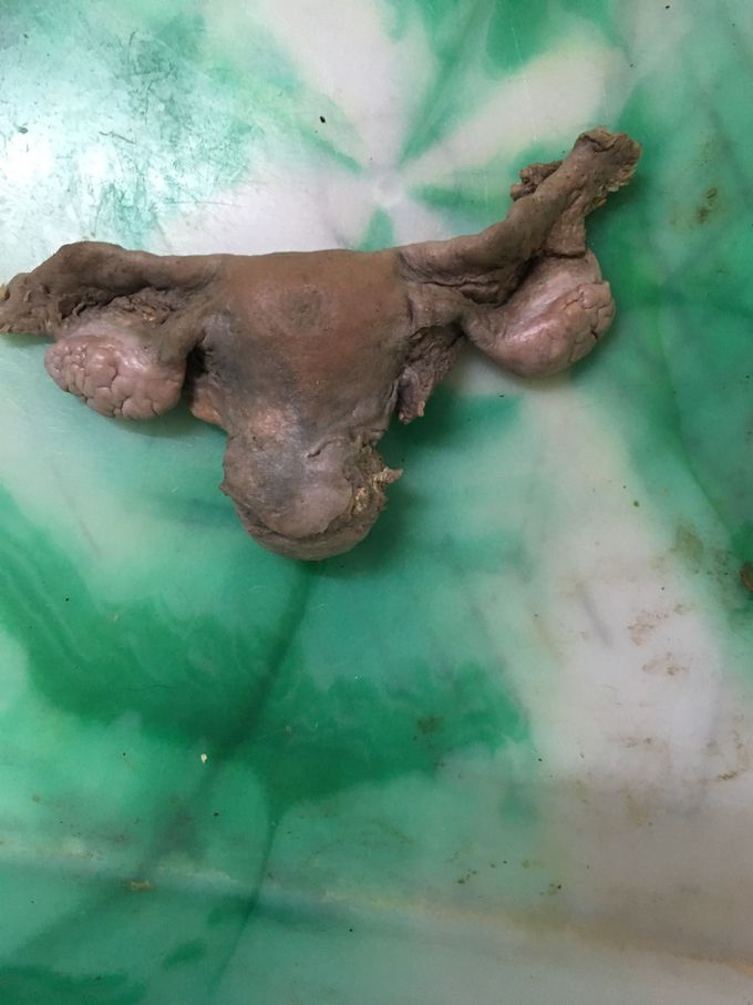 Nulliparous uterus