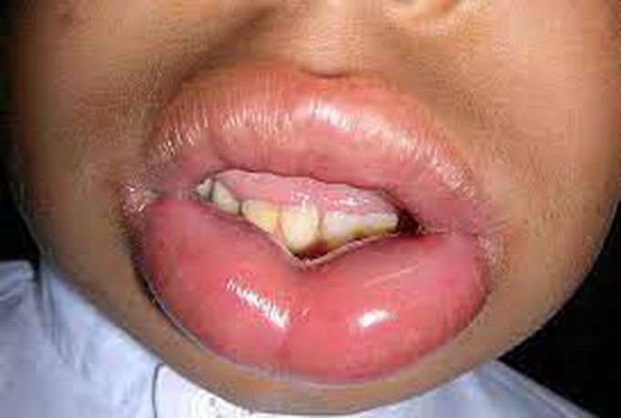 How is angioedema treated?