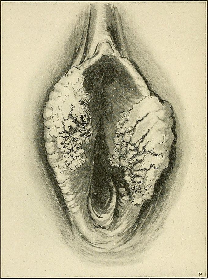 Causes of vulvul cancer