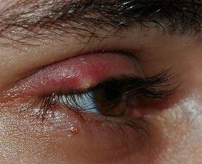 Do you know the name and bacterial cause of this condition?