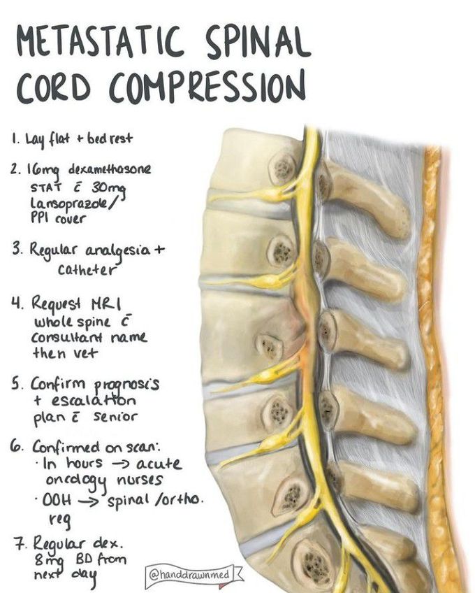 Metastatic spinalcord compression