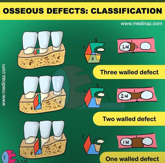 Osseous Defects- Classification