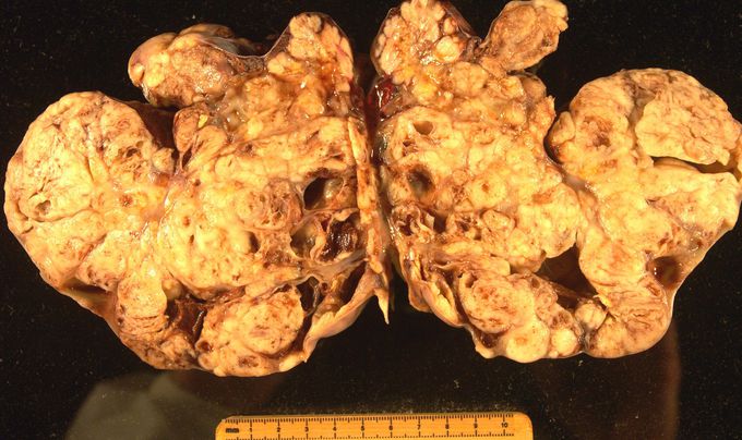 Risk Factors of Ovarian Cancer