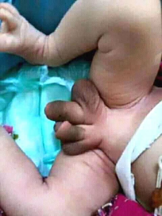 Congenital difect/abnormality