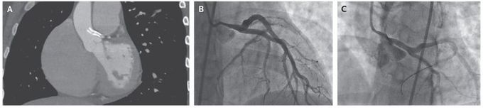 Left Main Coronary Artery Stent Migration