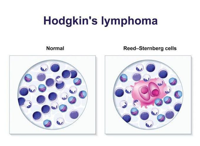 What causes Hodgkins lymphoma?