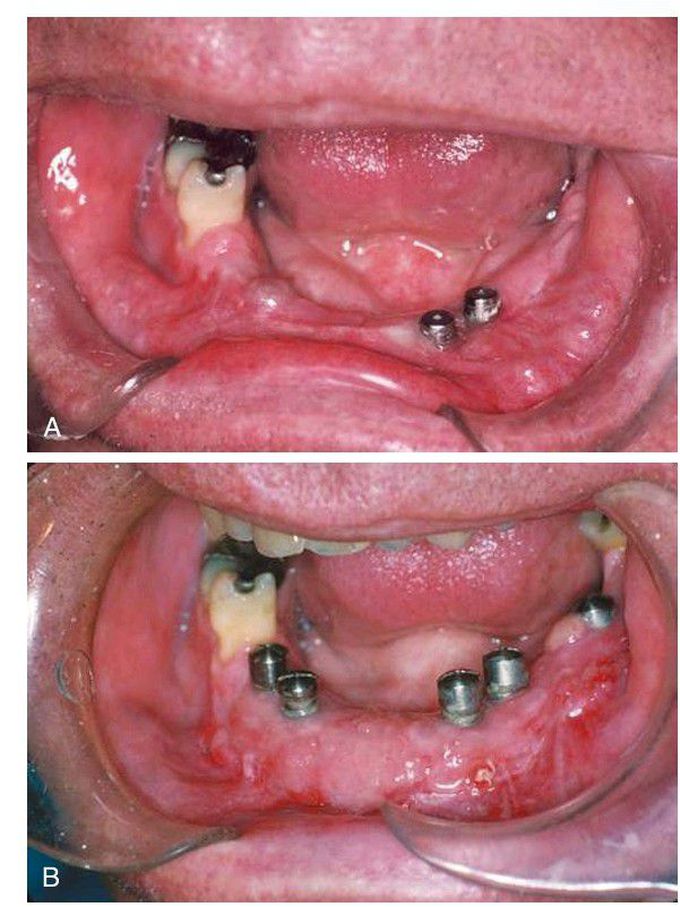 Vestibuloplasty