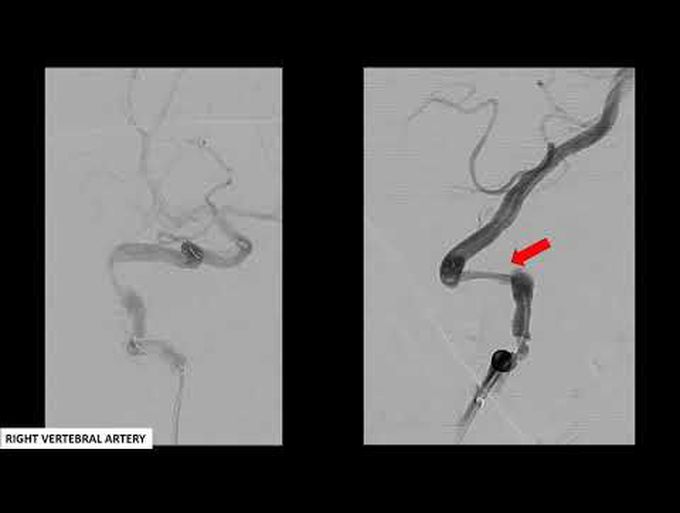 Combined reconstructive and deconstructive endovascular approach for bilateral VA dissection w/ SAH