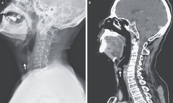 Vocal-Cord Polyp Causing Airway Obstruction