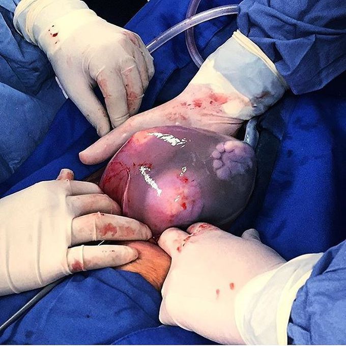 Cutest feet peeking from an enclosed amniotic sac during a C-section!